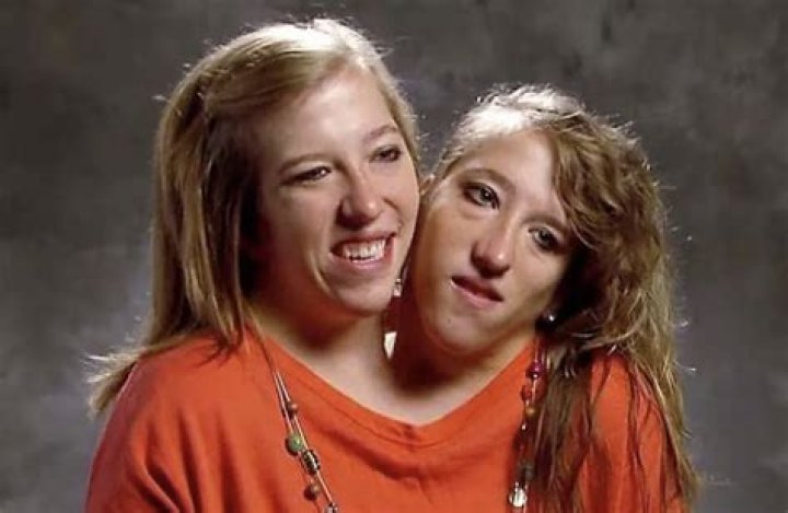 Conjoined Twins Abby and Brittany Hensel Decide on Procreation